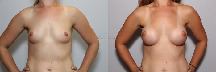 Before & After Breast Augmentation Case 89 View #1 View in St. Louis, MO