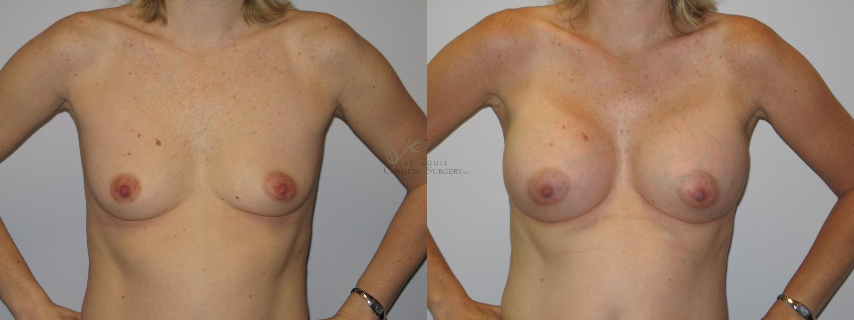 Before & After Breast Augmentation Case 90 View #1 View in St. Louis, MO