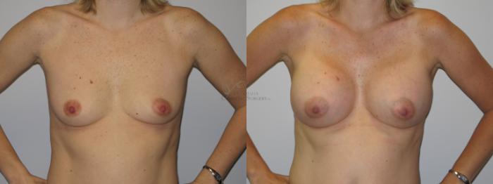 Before & After Breast Augmentation Case 90 View #1 View in St. Louis, MO