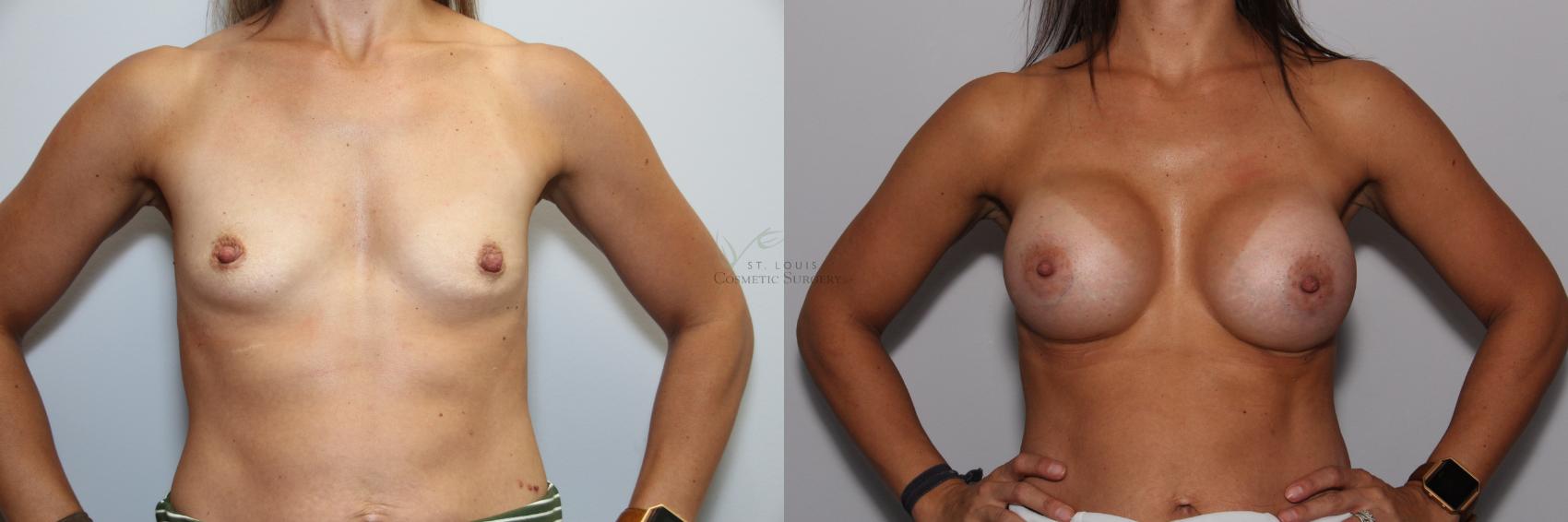 Before & After Breast Augmentation Case 91 View #1 View in St. Louis, MO