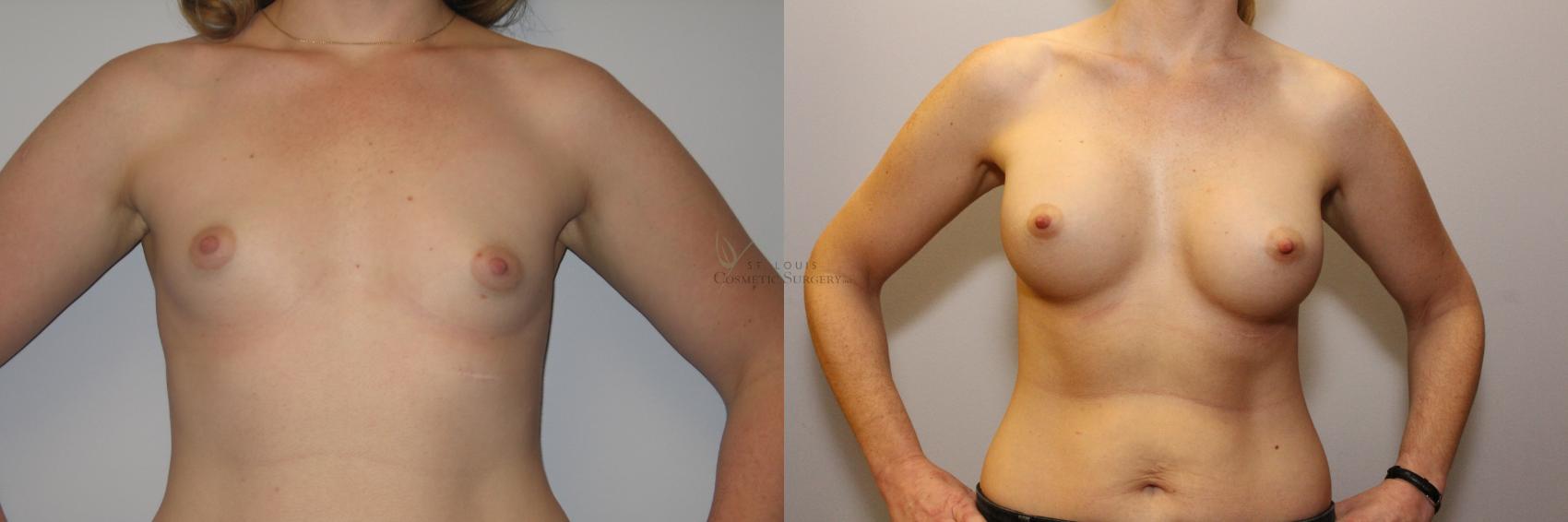 Before & After Breast Augmentation Case 96 View #1 View in St. Louis, MO