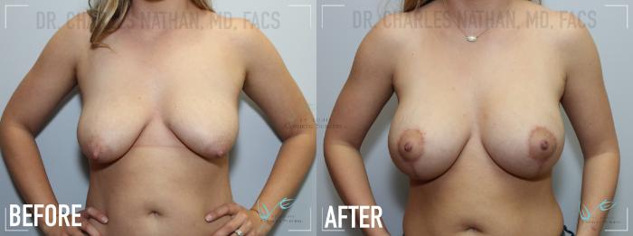 Before & After Breast Augmentation Case 140 Front View in St. Louis, MO