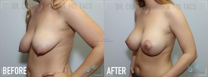 Before & After Breast Lift Case 140 Left Oblique View in St. Louis, MO
