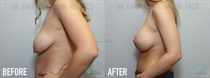 Before & After Breast Lift Case 140 Left Side View in St. Louis, MO