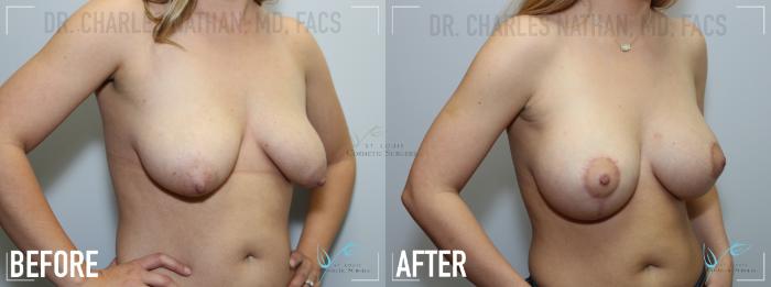 Before & After Breast Augmentation Case 140 Right Oblique View in St. Louis, MO