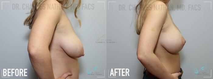 Before & After Breast Lift Case 140 Right Side View in St. Louis, MO