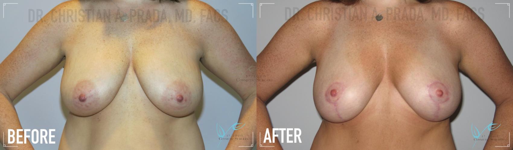 Before & After Breast Lift Case 155 Front View in St. Louis, MO