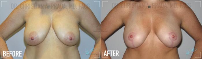 Before & After Breast Lift Case 155 Front View in St. Louis, MO