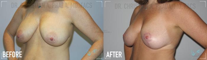 Before & After Breast Lift Case 155 Left Oblique View in St. Louis, MO