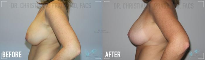 Before & After Breast Lift Case 155 Left Side View in St. Louis, MO