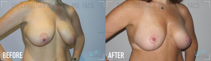 Before & After Breast Lift Case 155 Right Oblique View in St. Louis, MO
