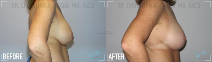 Before & After Breast Lift Case 155 Right Side View in St. Louis, MO