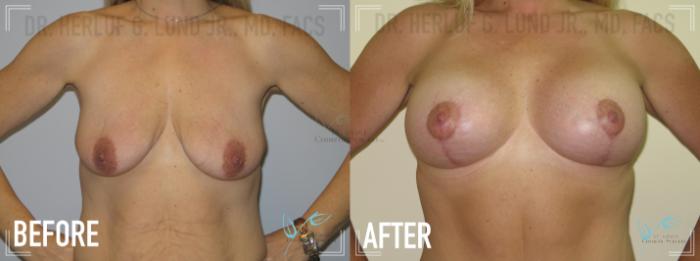 Before & After Breast Lift Case 161 Front View in St. Louis, MO
