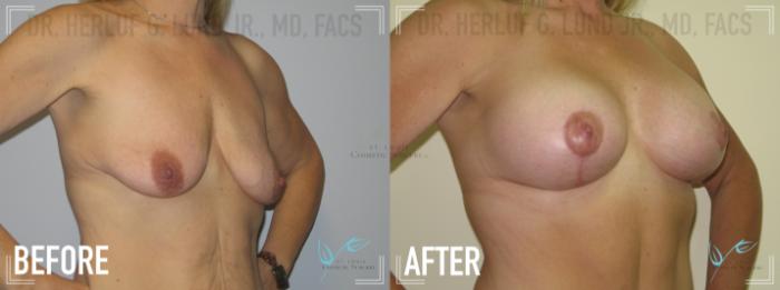 Before & After Breast Lift Case 161 Right Oblique View in St. Louis, MO