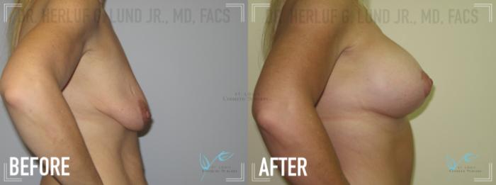 Before & After Breast Augmentation Case 161 Right Side View in St. Louis, MO