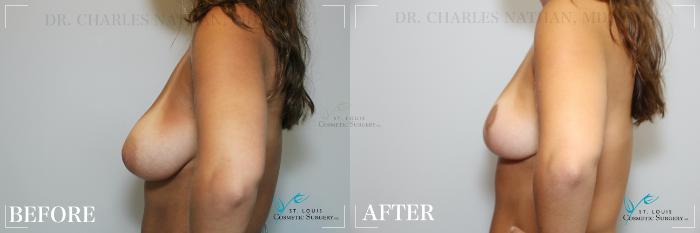 Before & After Breast Lift Case 174 Left Side View in St. Louis, MO