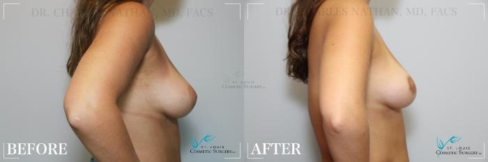 Before & After Breast Lift Case 174 Right Side View in St. Louis, MO