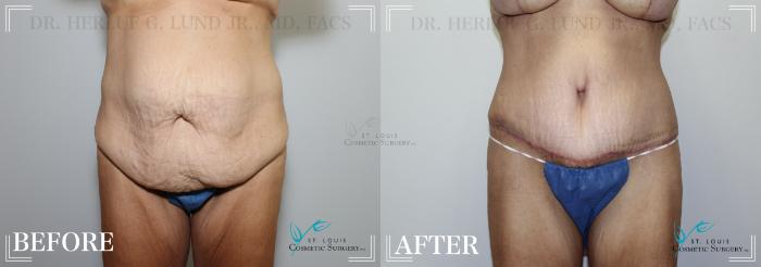 Before & After Breast Augmentation Case 181 Front- Abdominoplasty View in St. Louis, MO