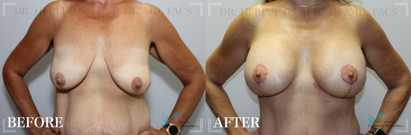 Before & After Breast Lift Case 181 Front View in St. Louis, MO