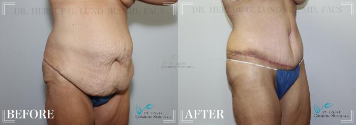 Before & After Tummy Tuck Case 181 Right Oblique- Abdominoplasty View in St. Louis, MO