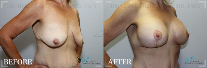 Before & After Breast Augmentation Case 181 Right Oblique View in St. Louis, MO