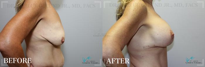 Before & After Breast Lift Case 181 Right Side View in St. Louis, MO