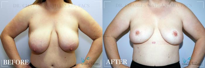 Before & After Breast Lift Case 187 Front View in St. Louis, MO