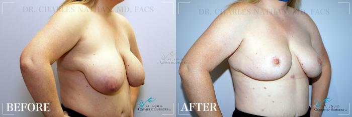Before & After Breast Lift Case 187 Right Oblique View in St. Louis, MO
