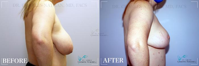 Before & After Breast Lift Case 187 Right Side View in St. Louis, MO