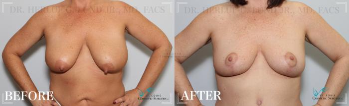 Before & After Breast Lift Case 190 Front View in St. Louis, MO
