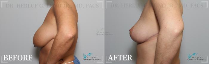 Before & After Breast Lift Case 190 Left Side View in St. Louis, MO