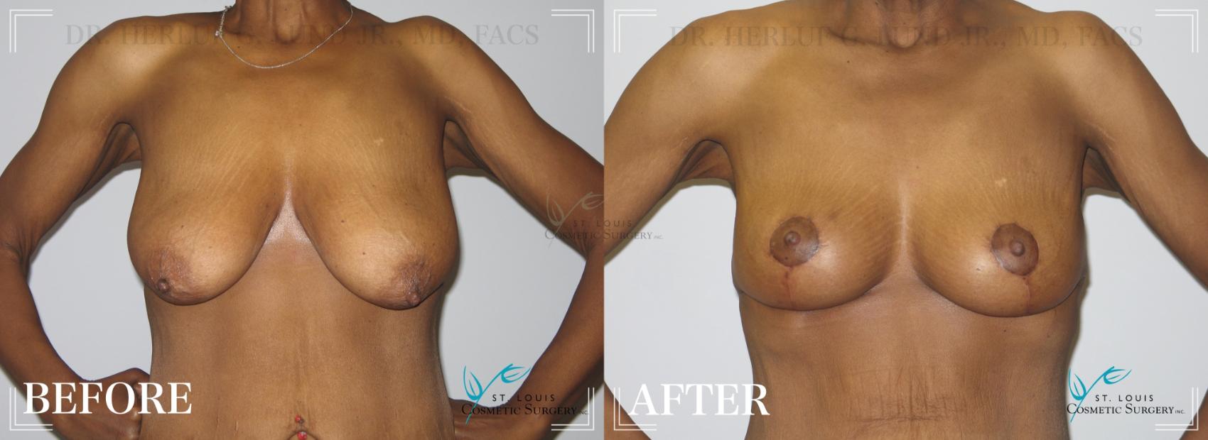 Before & After Breast Lift Case 192 Front View in St. Louis, MO