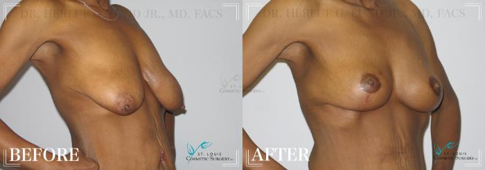 Before & After Breast Lift Case 192 Right Oblique View in St. Louis, MO