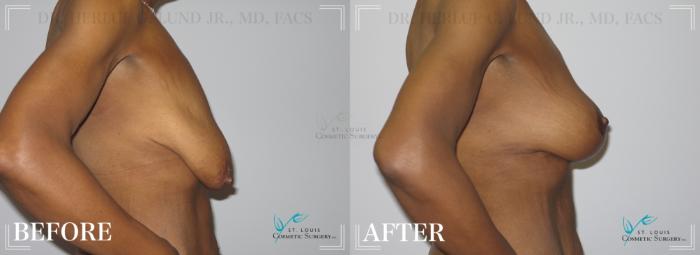 Before & After Breast Lift Case 192 Right Side View in St. Louis, MO