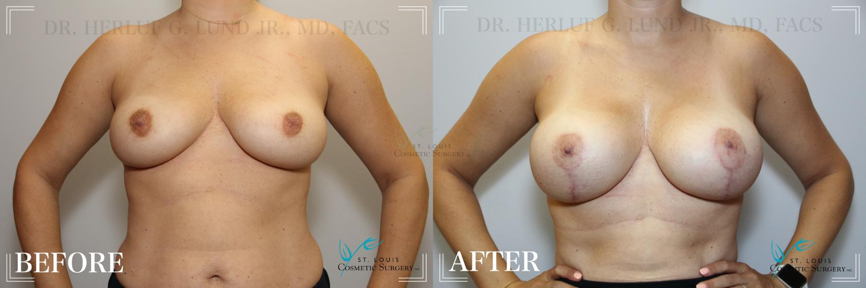 Breast Lift Before & After Photo | St. Louis, MO | St. Louis Cosmetic Surgery