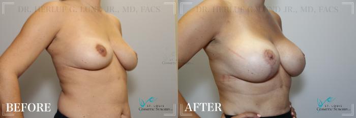 Before & After Breast Lift Case 195 Right Oblique View in St. Louis, MO