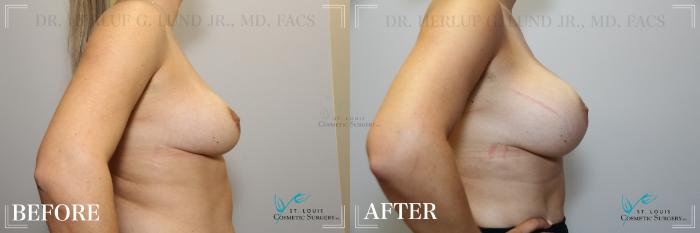 Before & After Breast Lift Case 195 Right Side View in St. Louis, MO