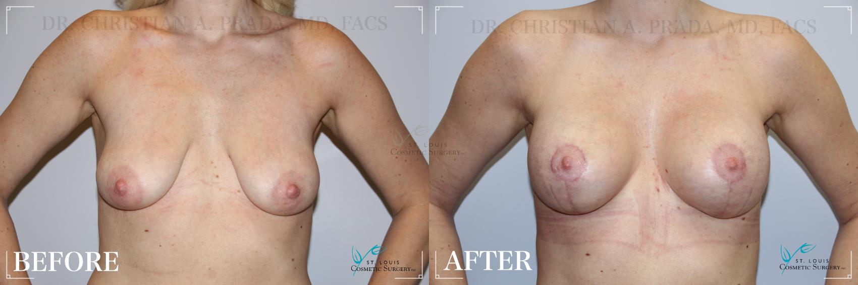 Before & After Breast Lift Case 196 Front View in St. Louis, MO