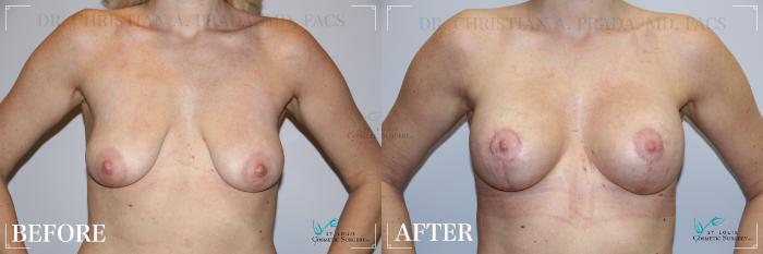 Before & After Breast Lift Case 196 Front View in St. Louis, MO