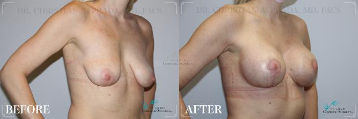 Before & After Breast Lift Case 196 Right Oblique View in St. Louis, MO