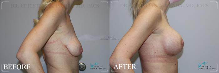 Before & After Breast Lift Case 196 Right Side View in St. Louis, MO