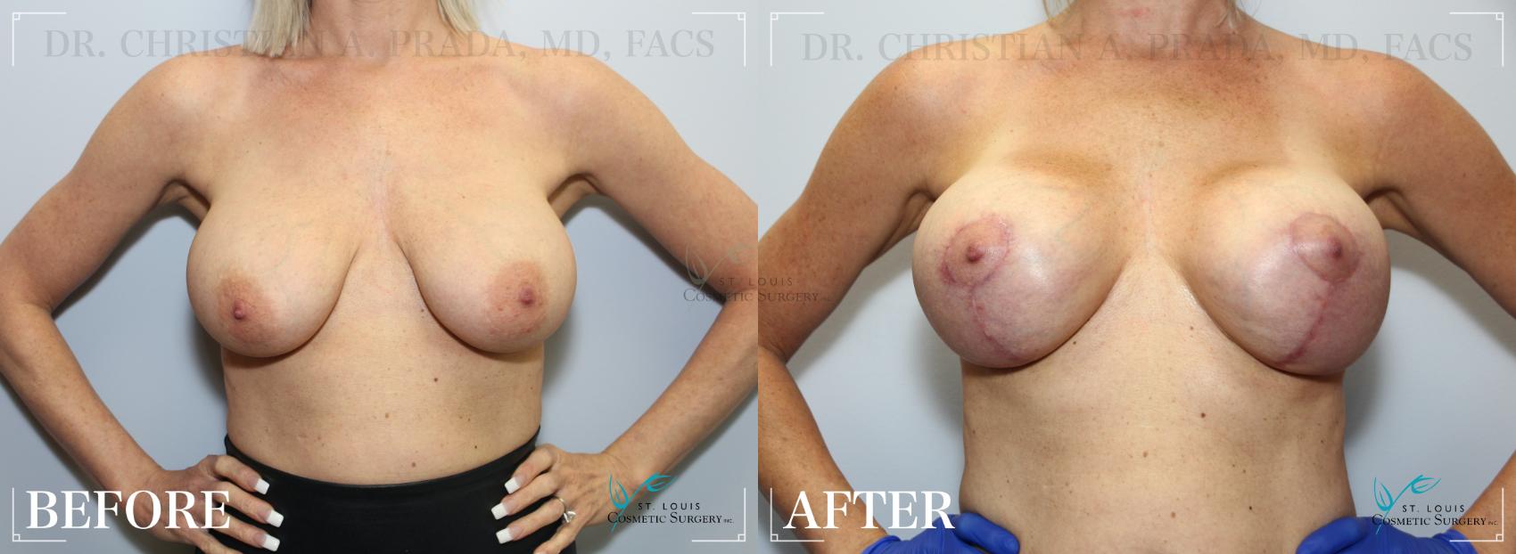 Before & After Breast Lift Case 212 Front View in St. Louis, MO