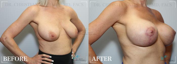 Before & After Breast Augmentation Case 212 Right Oblique View in St. Louis, MO