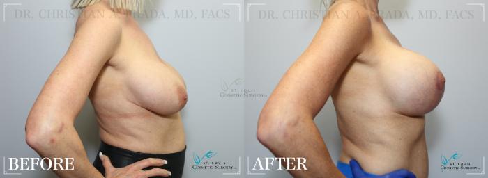 Before & After Breast Lift Case 212 Right Side View in St. Louis, MO