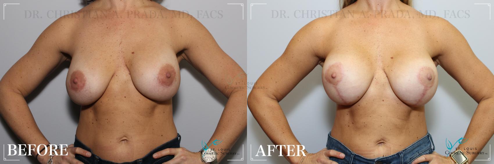 Before & After Breast Lift Case 228 Front View in St. Louis, MO