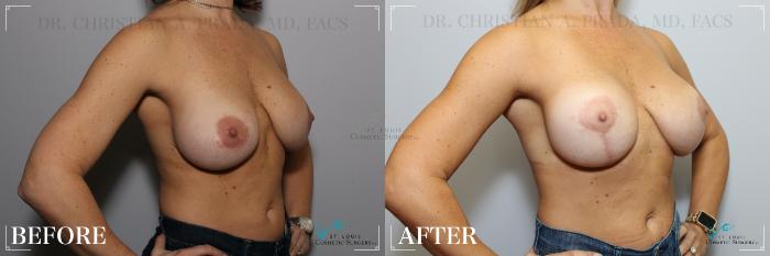 Before & After Breast Lift Case 228 Right Oblique View in St. Louis, MO