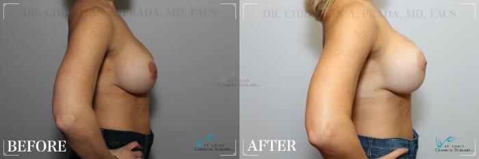 Before & After Breast Lift Case 228 Right Side View in St. Louis, MO