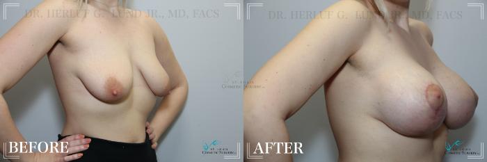 Before & After Breast Augmentation Case 247 Right Oblique View in St. Louis, MO
