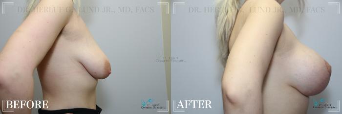 Before & After Breast Augmentation Case 247 Right Side View in St. Louis, MO