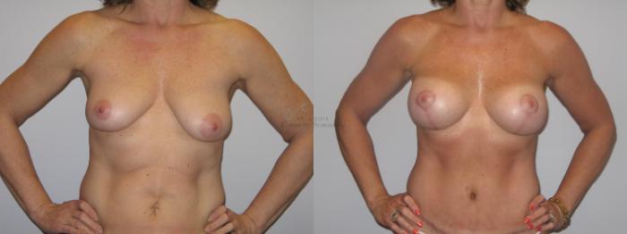 Before & After Breast Lift Case 25 View #1 View in St. Louis, MO